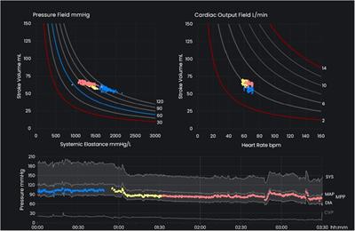 The pressure field model: a challenge to the conventional Starling and Guyton model of hemodynamic management